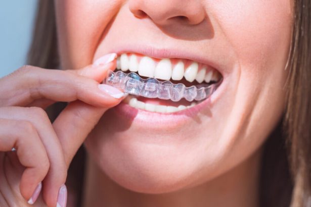 how-do-clear-aligners-work-to-straighten-teeth?