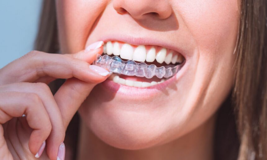 how-do-clear-aligners-work-to-straighten-teeth?